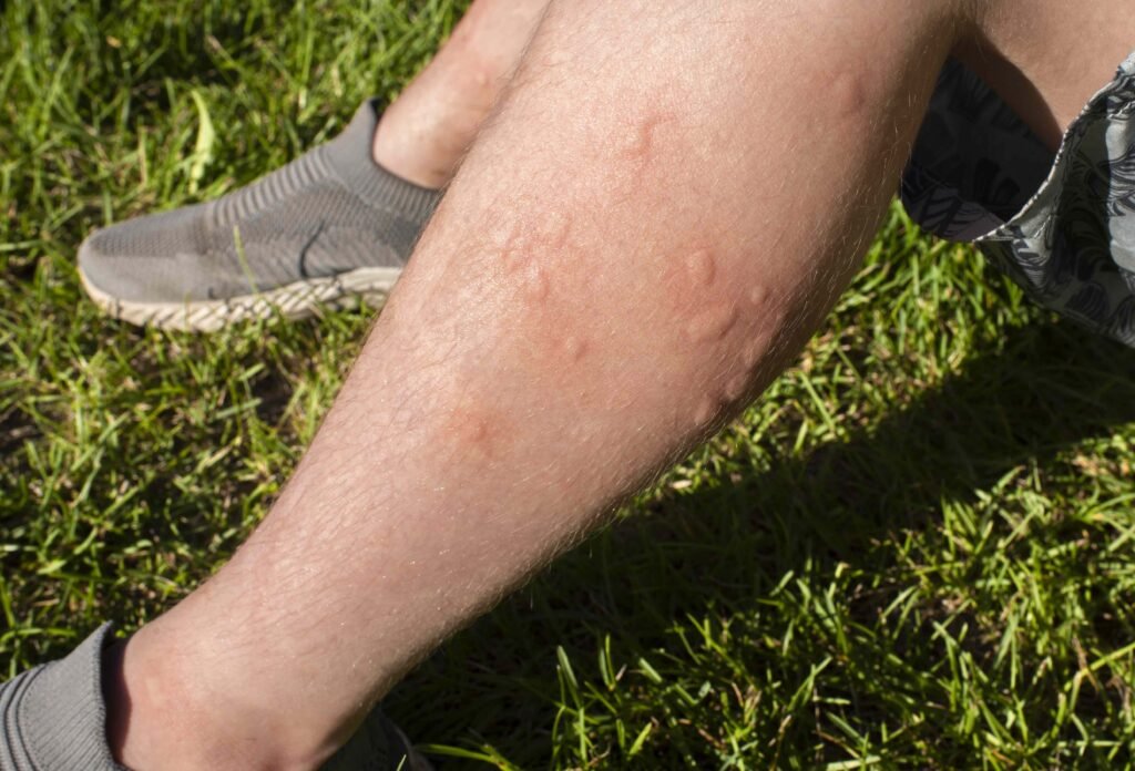 What Blood Type Do Mosquitoes Like Best?