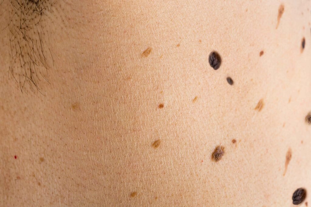 Why Do Some People Have So Many Moles?