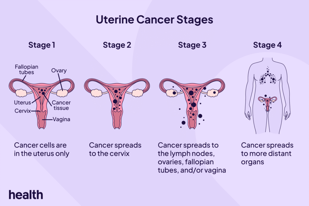 The 4 Stages of Uterine Cancer—and What Each One Means