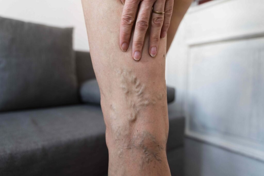 Varicose Veins Aren't Always Just a Cosmetic Issue—Here's When They Need Treatment