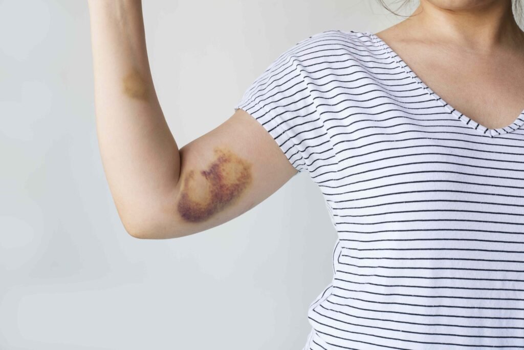 What To Know About Hemophilia, a Rare Blood Disorder