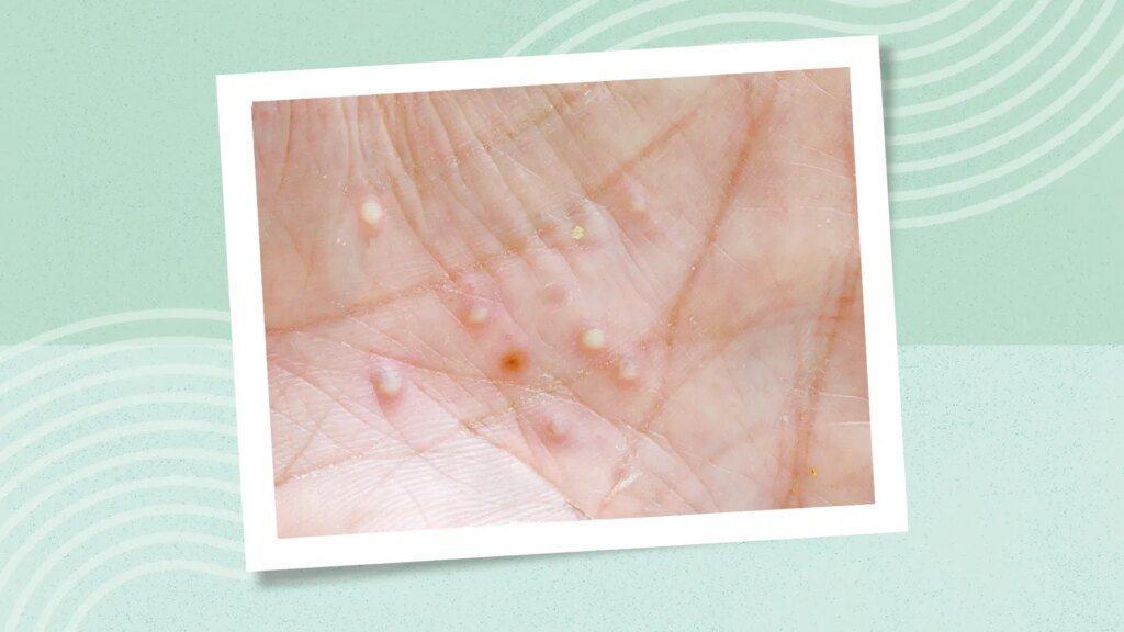 Localized Pustular Psoriasis: What It Is and How It’s Managed