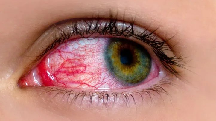 Pink Eye: Common Myths and Facts Pink Eye: Common Myths and Facts