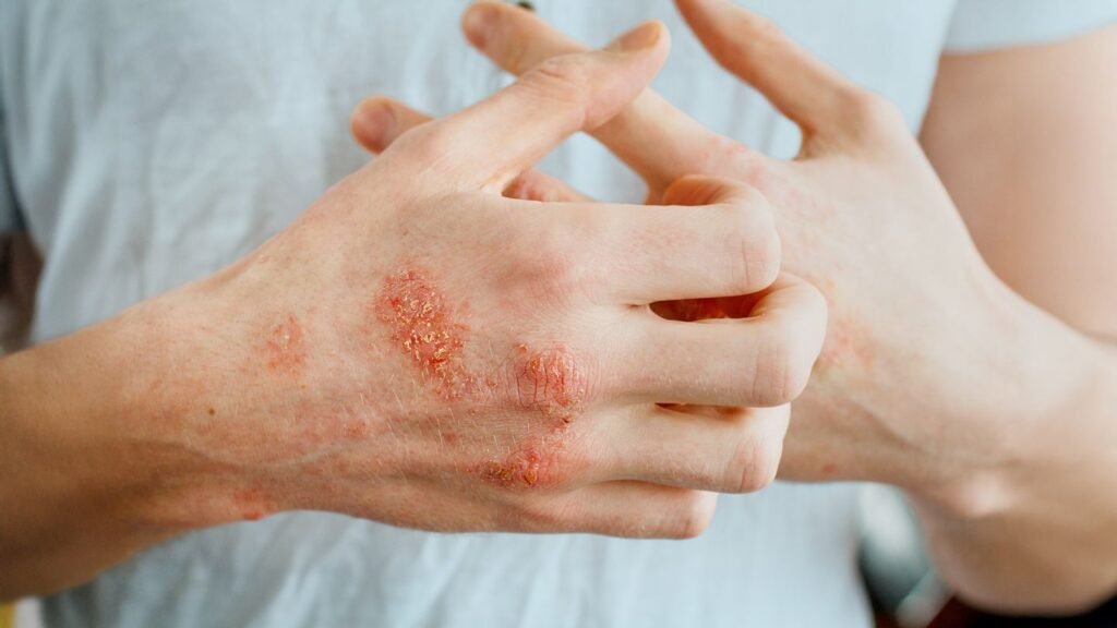 Is Your Atopic Dermatitis Well-Controlled? 3 Red Flags You Should Watch For Is Your Atopic Dermatitis Well-Controlled? 3 Red Flags You Should Watch For