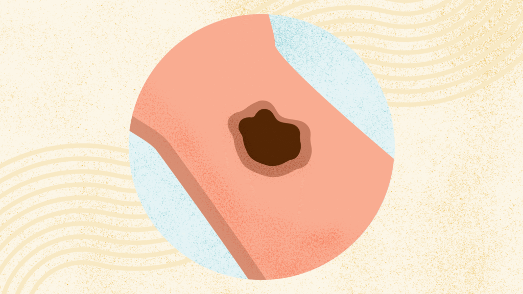 What Is Melanoma? What Is Melanoma?