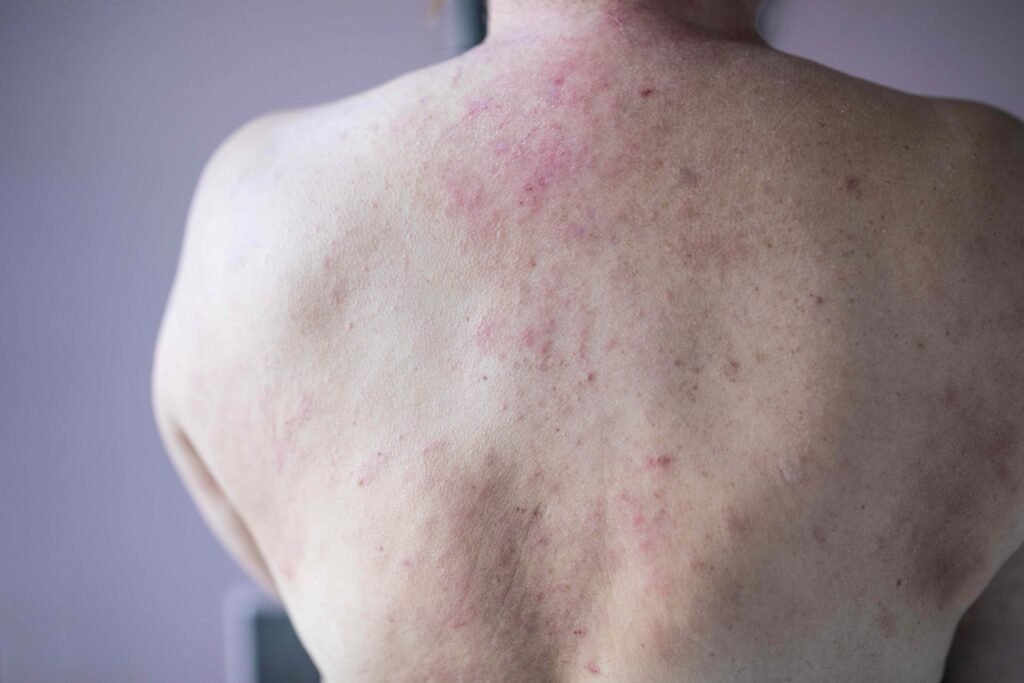 Why Do Some People Develop Long-Term Hives, or Chronic Spontaneous Urticaria?