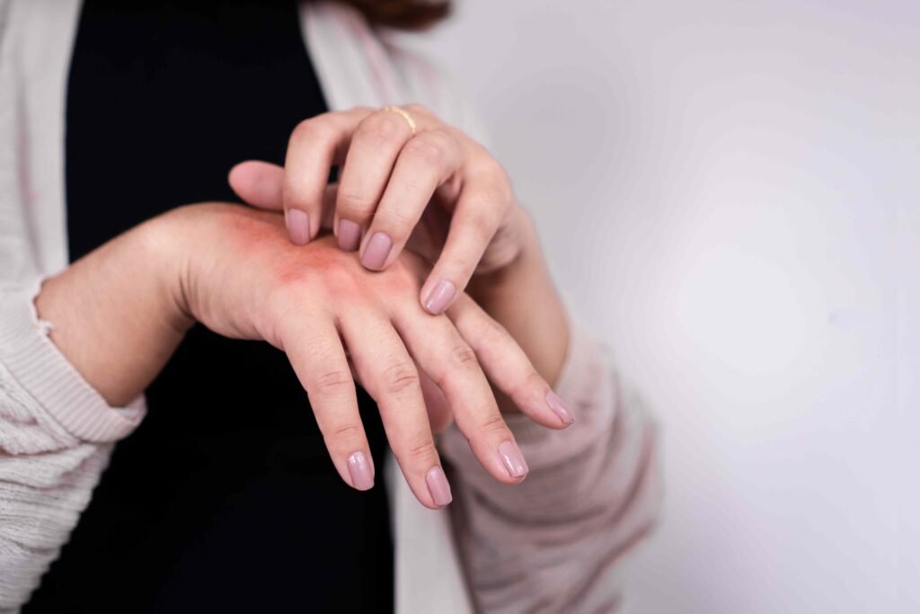 6 Ways To Manage Chronic Hives