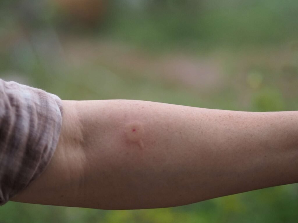 How Do You Know if a Wasp Sting Is Serious?