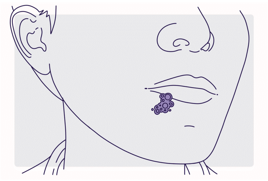 Types, Symptoms, Causes, Treatment, and More Types, Symptoms, Causes, Treatment, and More