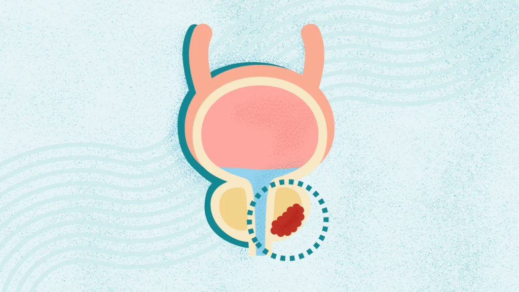 What Is Prostate Cancer? Symptoms, Stages, Diagnosis, Treatment, and More What Is Prostate Cancer? Symptoms, Stages, Diagnosis, Treatment, and More