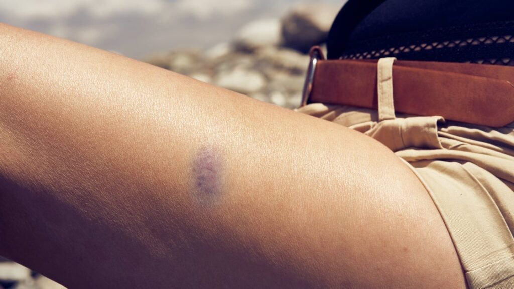 Having Mysterious Bruises All The Time Could Be A Sign of ADHD
